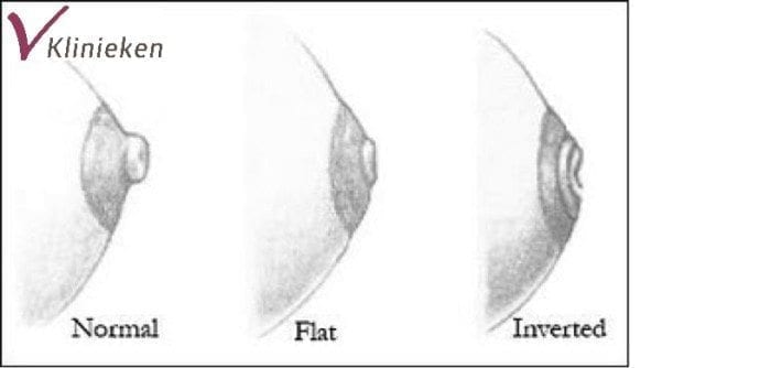 dynamisch Zeeziekte historisch Last van een ingetrokken tepel? Kom langs bij V Klinieken.